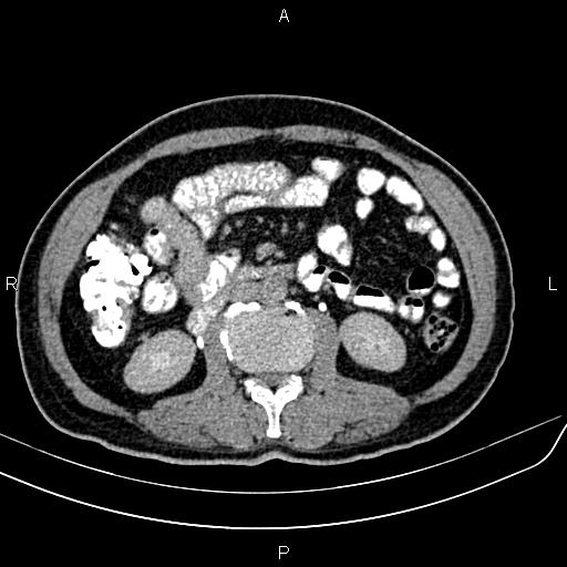 File:Cecal cancer with appendiceal mucocele (Radiopaedia 91080-108651 Axial C+ delayed 31).jpg