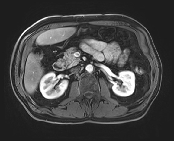 Cecal mass causing appendicitis (Radiopaedia 59207-66532 H 58).jpg