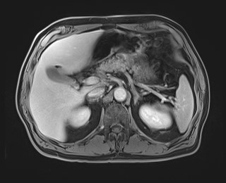 Cecal mass causing appendicitis (Radiopaedia 59207-66532 J 44).jpg