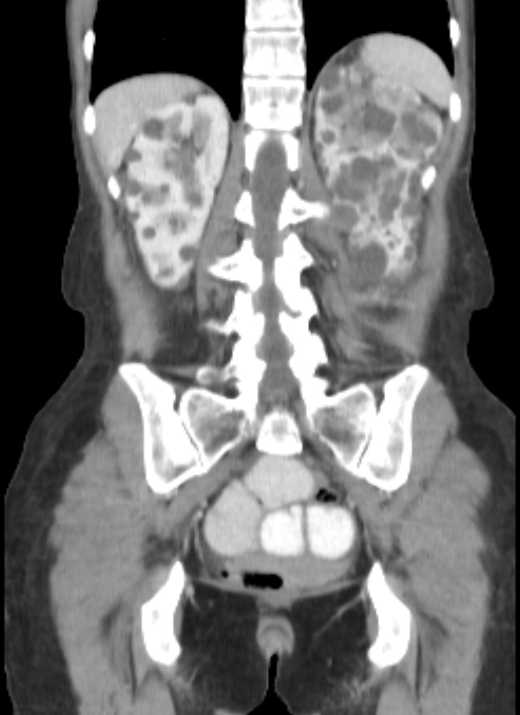 Cecal volvulus with pneumatosis coli (Radiopaedia 68572-78178 B 15).jpg