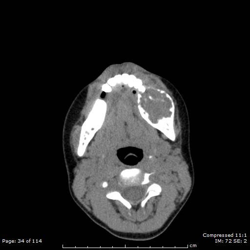 File:Central giant cell granuloma (Radiopaedia 45612-49754 Axial non-contrast 17).jpg