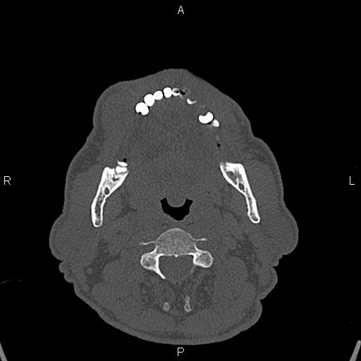 Central giant cell granuloma (Radiopaedia 83346-97761 Axial bone window 5).jpg