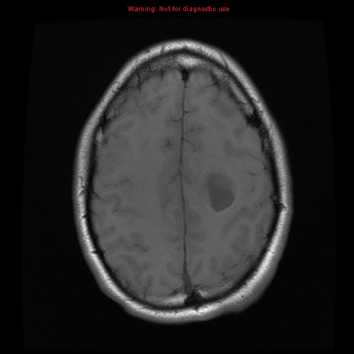 File:Central neurocytoma (Radiopaedia 13188-13206 Axial T1 8).jpg