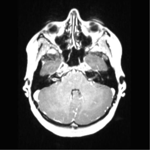 File:Central neurocytoma (Radiopaedia 37664-39557 Axial T1 C+ 22).png
