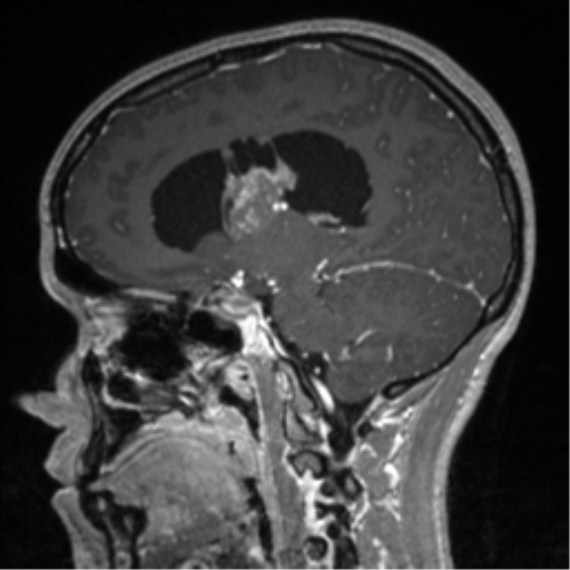 File:Central neurocytoma (Radiopaedia 37664-39557 Sagittal T1 C+ 42).png