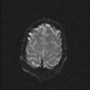 Central neurocytoma (Radiopaedia 56690-63469 Axial DWI 18).jpg