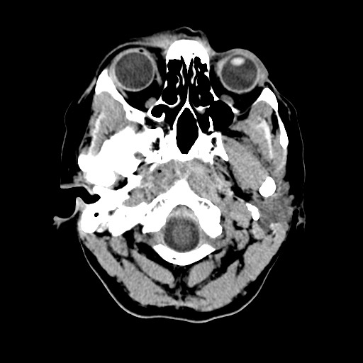 Central neurocytoma (Radiopaedia 68725-78432 Axial non-contrast 3).jpg
