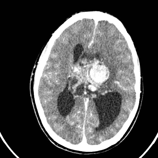 Central neurocytoma (Radiopaedia 84497-99871 B 26).jpg