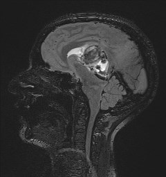Central neurocytoma (Radiopaedia 84497-99872 Sagittal Flair + Gd 82).jpg