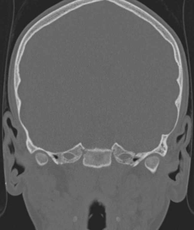 Cerebellar abscess (Radiopaedia 73727-84527 Coronal bone window 86).jpg