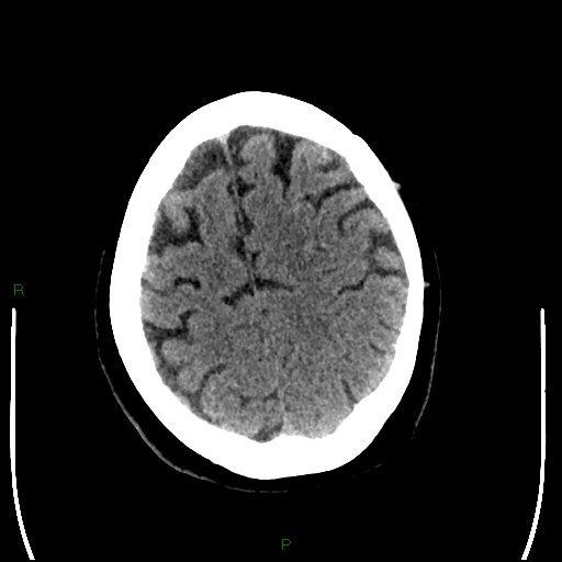 Cerebellar abscess (Radiopaedia 78135-90671 Axial non-contrast 87).jpg