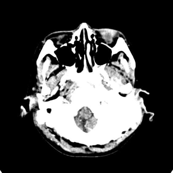 Cerebellar abscess secondary to mastoiditis (Radiopaedia 26284-26412 Axial C+ delayed 15).jpg