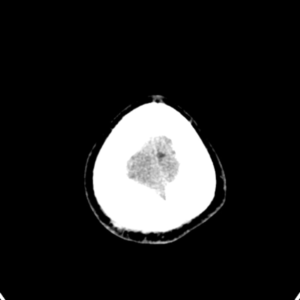 Cerebellar abscess secondary to mastoiditis (Radiopaedia 26284-26412 Axial non-contrast 149).jpg
