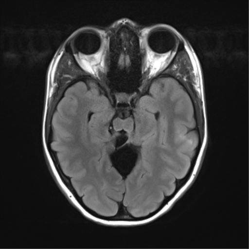 File:Cerebellar agenesis with hypoplastic pons (pontocerebellar hypoplasia) (Radiopaedia 57224-64138 Axial FLAIR 12).png