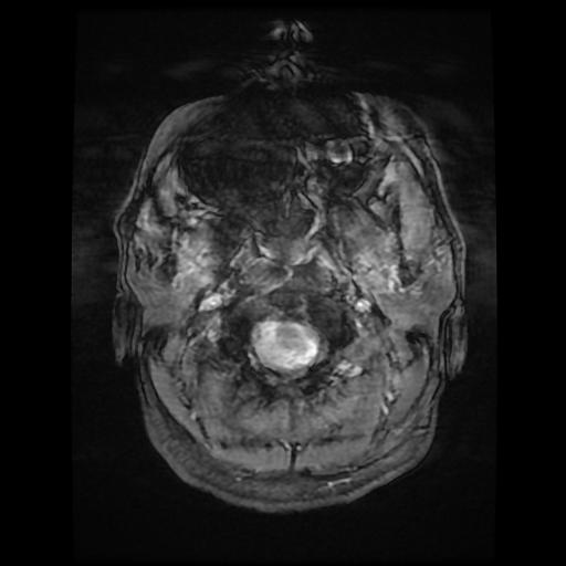 File:Cerebellar hemangioblastoma (Radiopaedia 88055-104622 Axial Gradient Echo 1).jpg