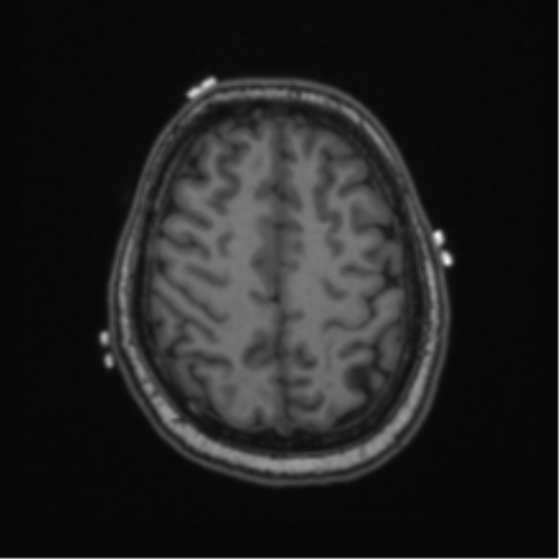 Cerebellar hemangioblastomas and pituitary adenoma (Radiopaedia 85490-101176 Axial T1 57).png