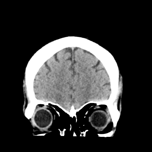 File:Cerebellar hemorrhage (Radiopaedia 37000-38669 Coronal non-contrast 9).png