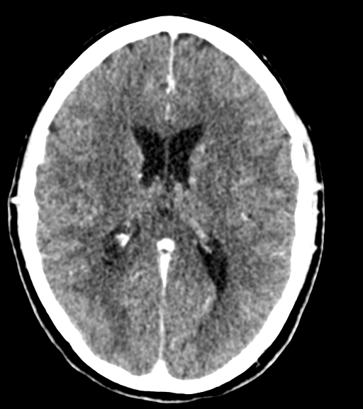 Cerebellar metastases - colorectal adenocarcinoma (Radiopaedia 40947-43652 Axial C+ 34).png