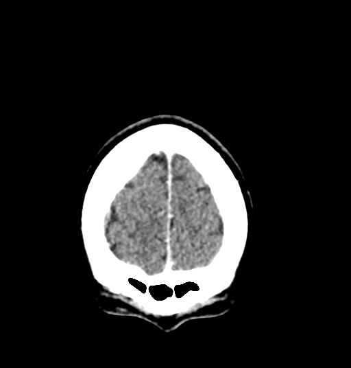 Cerebellar metastases - colorectal adenocarcinoma (Radiopaedia 40947-43652 Coronal C+ 13).png