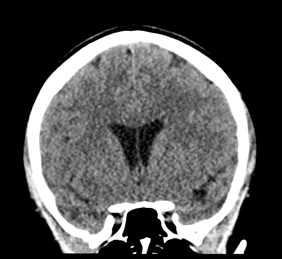 Cerebellar metastases - colorectal adenocarcinoma (Radiopaedia 40947-43652 Coronal non-contrast 39).png
