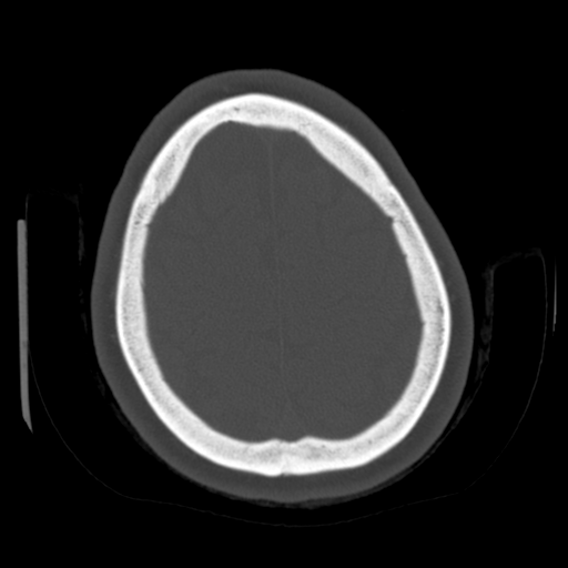 Cerebellar metastasis (cystic appearance) (Radiopaedia 41395-44258 Axial bone window 58).png
