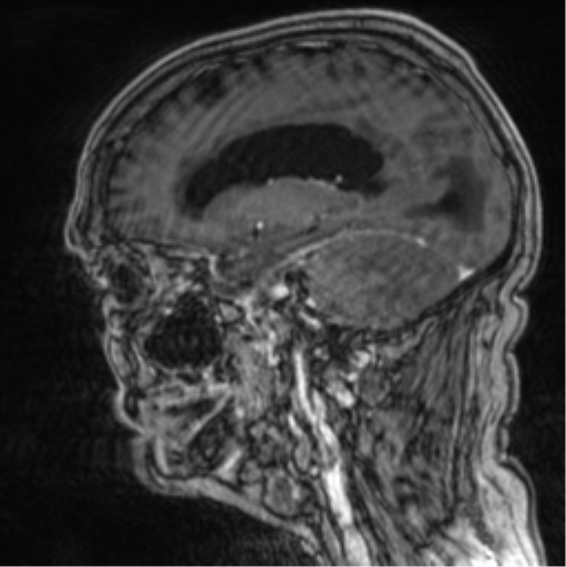 Cerebellar metastasis from lung adenocarcinoma (Radiopaedia 86690-102829 Sagittal T1 C+ 32).png