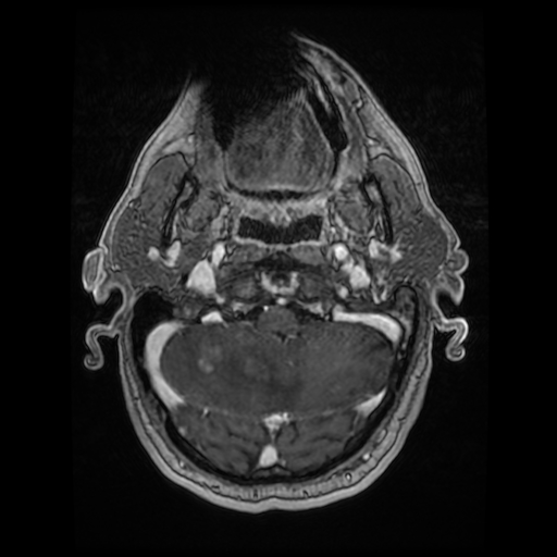 Cerebellar metastasis of pulmonary adenocarcinoma, cavernous venous malformation, and developmental venous anomaly (Radiopaedia 85827-101661 Axial T1 C+ 22).jpg