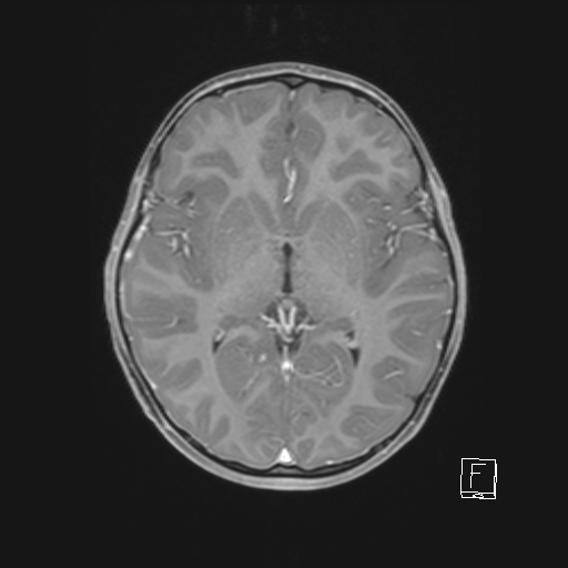 Cerebellar stroke (Radiopaedia 32202-33150 Axial T1 C+ 39).png