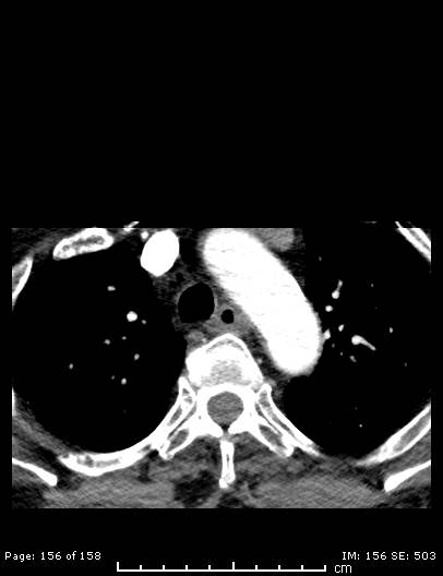Cerebellar strokes due to intracranial giant cell arteritis (Radiopaedia 68799-78510 CT angiogram 156).jpg