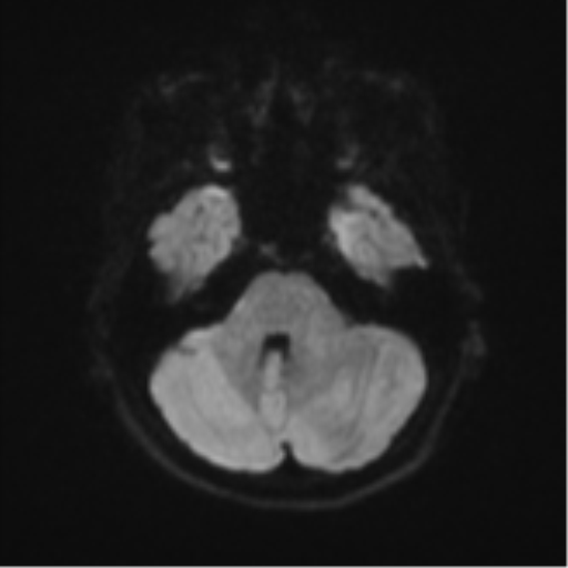 Cerebellar tuberculomas (Radiopaedia 46939-51472 Axial DWI 36).png