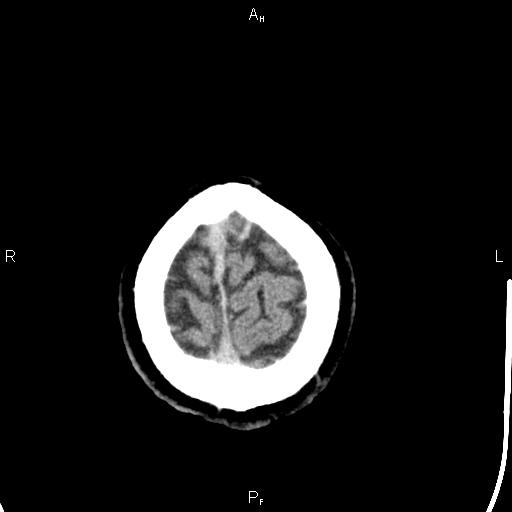 File:Cerebellopontine angle arachnoid cyst (Radiopaedia 85149-100704 Axial With contrast 50).jpg