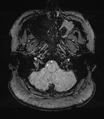 Cerebellopontine angle meningioma (Radiopaedia 48434-53348 Axial SWI 12).png