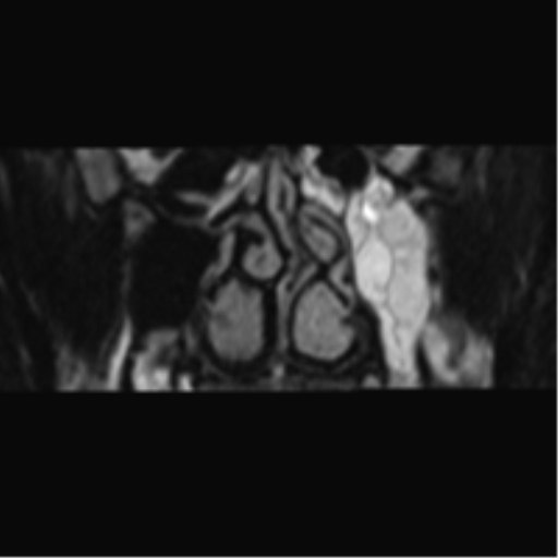 Cerebellopontine angle meningioma (Radiopaedia 48434-53348 Coronal T2 99).png