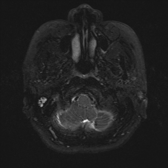 Cerebellopontine angle meningioma (Radiopaedia 53561-59591 Axial 3D volume T2 11).jpg