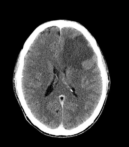 Cerebral abscess (Radiopaedia 57774-64741 Axial C+ delayed 40).png