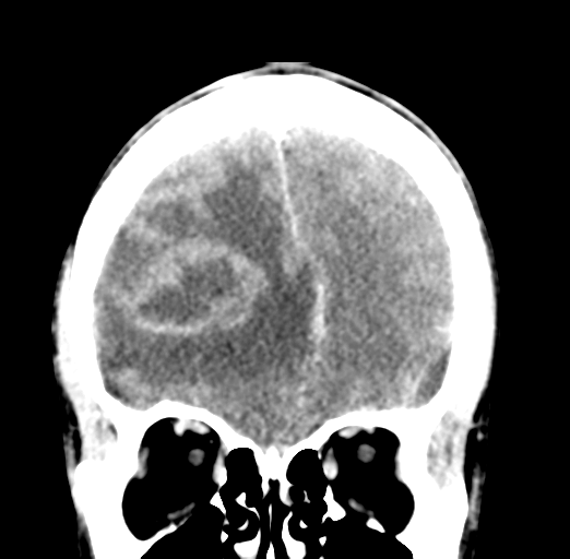Cerebral abscess (Radiopaedia 60342-68008 Coronal C+ delayed 18).png