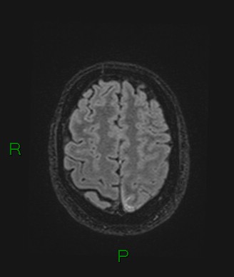 File:Cerebral abscess and subdural empyema (Radiopaedia 84436-99779 Axial FLAIR 21).jpg