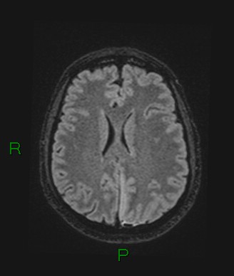 Cerebral abscess and subdural empyema (Radiopaedia 84436-99779 Axial FLAIR 34).jpg