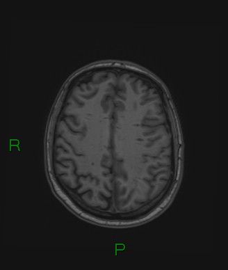 Cerebral abscess and subdural empyema (Radiopaedia 84436-99779 Axial T1 28).jpg