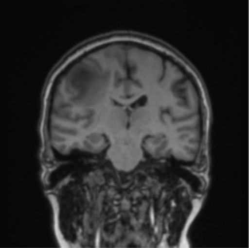 File:Cerebral abscess from pulmonary arteriovenous malformation (Radiopaedia 86275-102291 Coronal T1 43).png