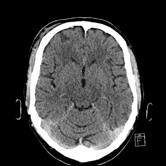 File:Cerebral abscess with ventriculitis (Radiopaedia 78965-91877 A 20).jpg
