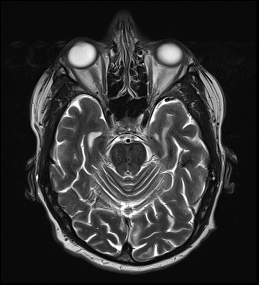 File:Cerebral abscess with ventriculitis (Radiopaedia 78965-91878 Axial T2 15).jpg