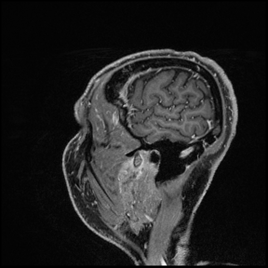 Cerebral abscess with ventriculitis (Radiopaedia 78965-91878 Sagittal T1 C+ 156).jpg