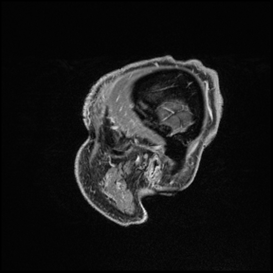 Cerebral abscess with ventriculitis (Radiopaedia 78965-91878 Sagittal T1 C+ 18).jpg