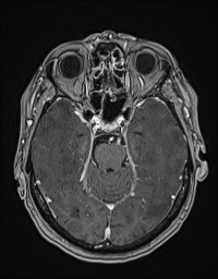 Cerebral amyloid angiopathy-related inflammation (Radiopaedia 58270-65377 Axial T1 C+ fat sat 47).jpg