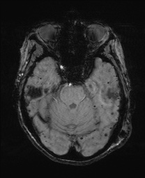File:Cerebral amyloid angiopathy-related inflammation (Radiopaedia 74836-85849 Axial SWI 23).jpg