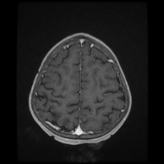 Cerebral and spinal tuberculosis (Radiopaedia 90489-107837 Axial T1 C+ 155).jpg