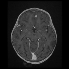 Cerebral and spinal tuberculosis (Radiopaedia 90489-107837 Axial T1 C+ 90).jpg