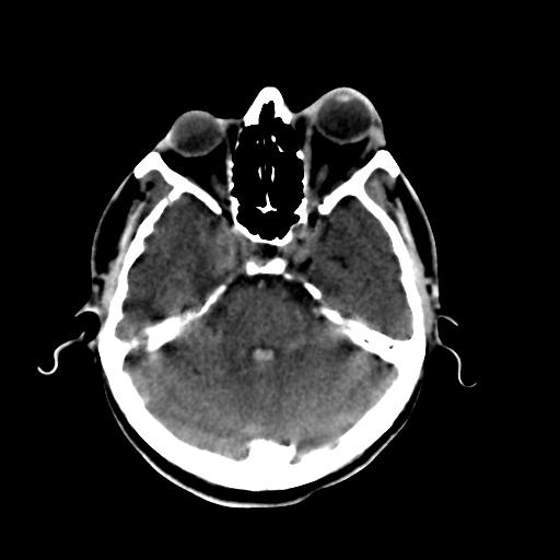 Cerebral arteriovenous malformation (Radiopaedia 28518-28759 Axial non-contrast 21).jpg