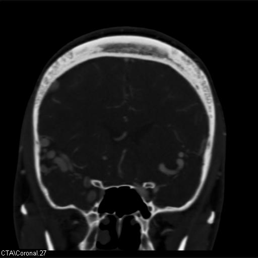 Cerebral arteriovenous malformation (Radiopaedia 28518-28759 C 27).jpg